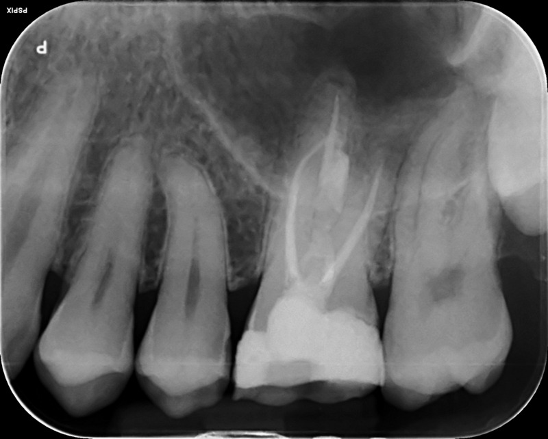 UL6 internal inflammatory resorption case image 6